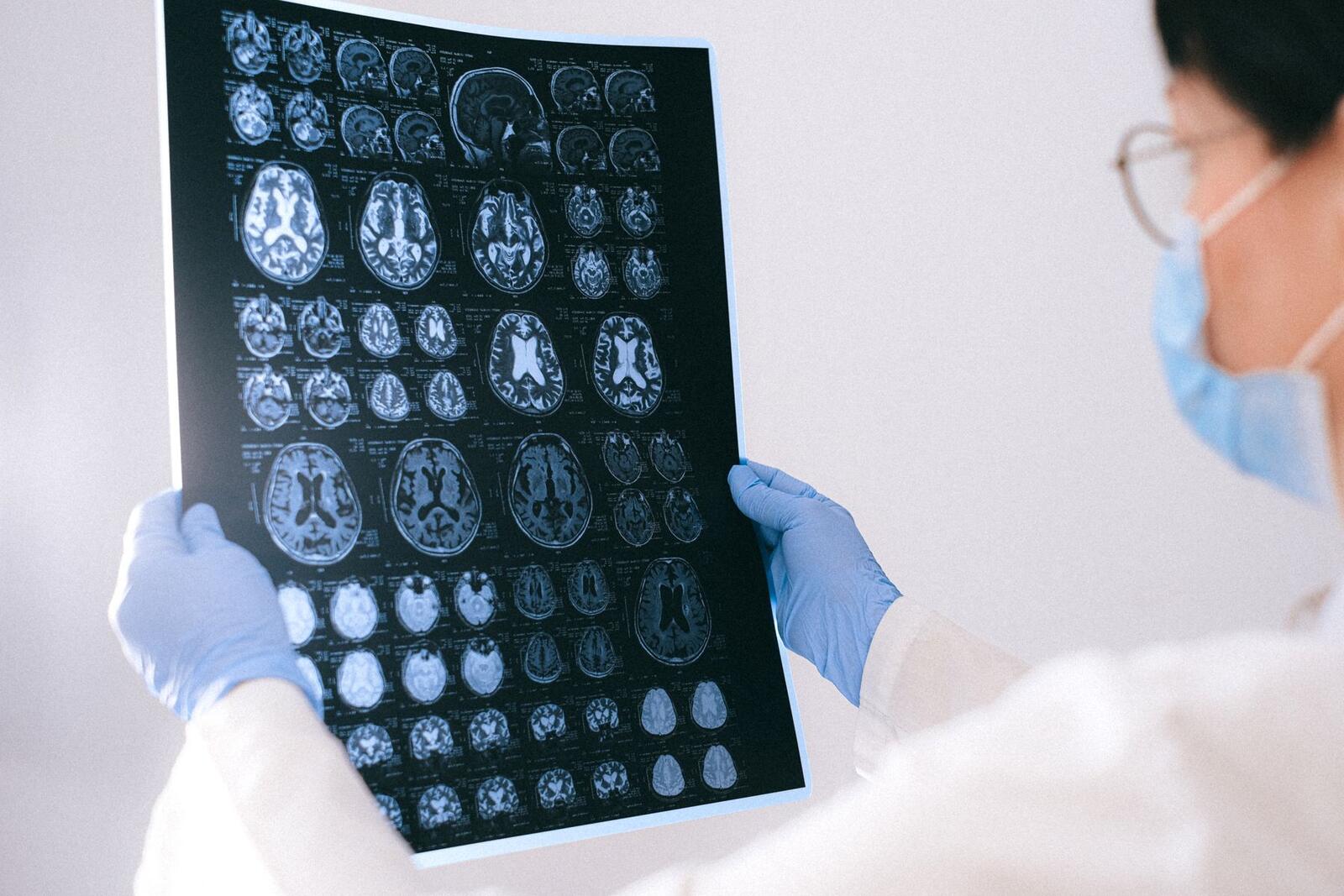 Medico che osserva una risonanza cerebrale